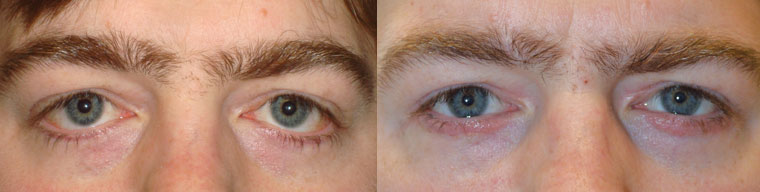 Santa Barbara Droopy Lower Eyelids Correction