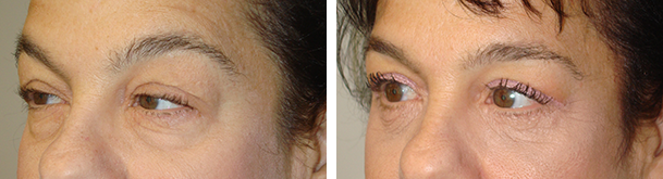Before (left) and 3 months after (right) quad-blepharoplasty and blepharoptosis surgery.