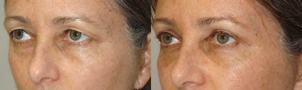 Beverly Hills Sagging Upper Eyelids Procedure
