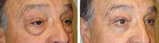 Before (left) and 6 weeks after (right) lower transconjuctival blepharoplasty.
