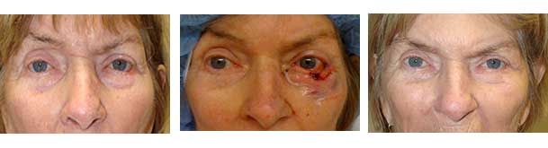 Before (left), intraop (middle) and 3-months after (far right) photos of a patient with large left lower eyelid skin cancer Mohs resection and reconstruction.