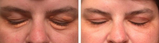 Before (left) and after (right) surgery for large eyelid xanthalasma (eyes closed).