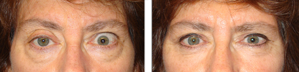 Before (left) and 3 months after (right photo) of right upper eyelid ptosis surgery, left upper eyelid retraction procedure and bilateral lower blepharoplasty.