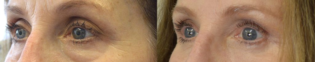 71 year old female, underwent cosmetic upper blepharoplasty, lower blepharoplasty (transconjunctival with fat repositioning and skin pinch), upper eyelid ptosis surgery, and lateral pretrichial brow lift, under local anesthesia.