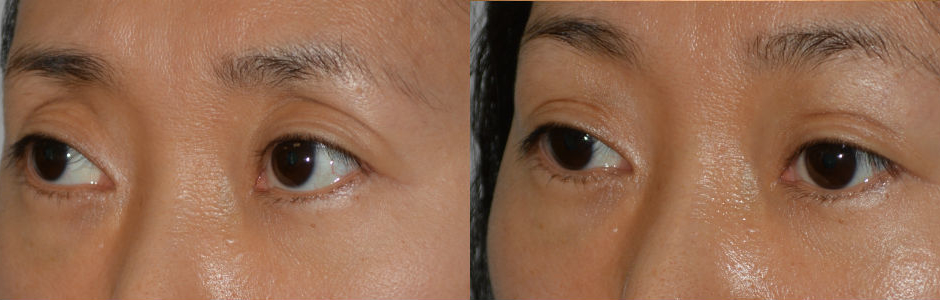 Young Asian female, with prior aggressive upper blepharoplasty, where too much fat was removed, resulting in hollow sunken upper eyelids, with excess folds. She received upper eyelid filler injection to give more natural Asian eyelids and shape. Before and 1 month after eyelid filler treatment photos are shown.