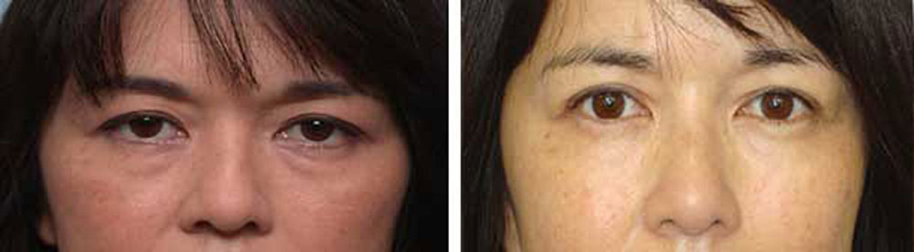 Middle age Asian woman, underwent Asian upper blepharoplasty and crease formation (using incision method), under local anesthesia in the office. Note natural appearing results. Before and 6 months postoperative photos are shown.