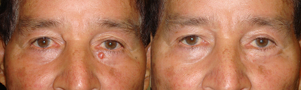 60 year old male, with left lower eyelid basal cell carcinoma. The eyelid skin cancer was removed and the eyelid reconstructed under sedation anesthesia. Note natural appearing results with minimal scarring. Before (left) and 3 months postoperative (right) photos are shown, and complete eyelid function.