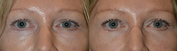 Revisional Eyelid Surgery Specialists in Los Angeles