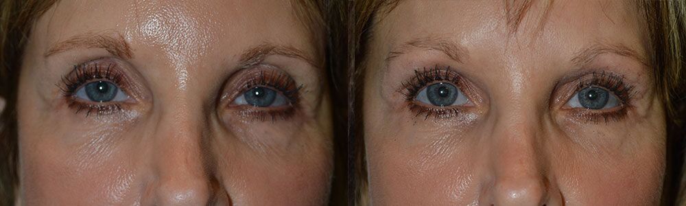 Before and After Second Eyelid Surgery in LA