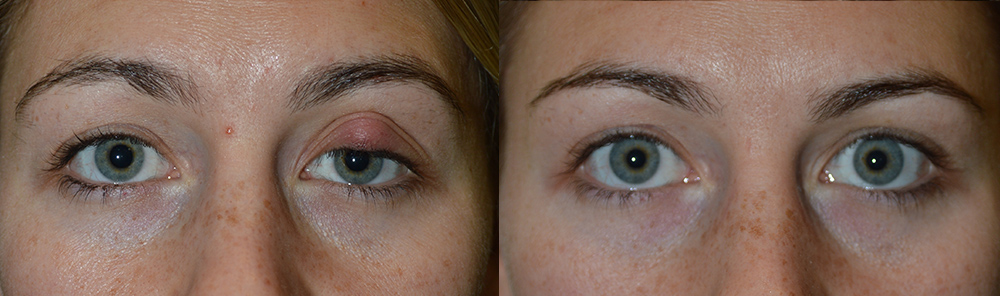 Ocular Infection Los Angeles Treatment