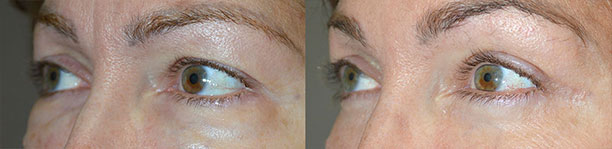 Revisional Eyelid Surgery in Los Angeles