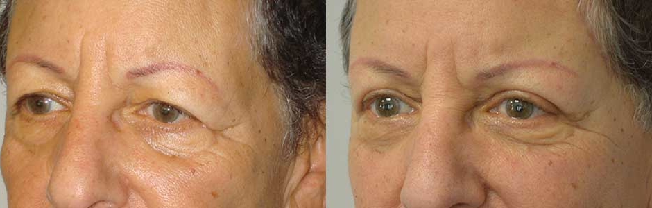 Browlifting Eyelid Surgery in Los Angeles