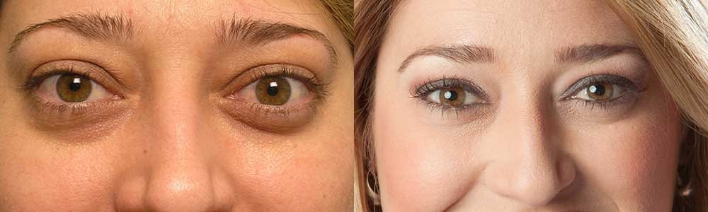 38 year old female, with thyroid eye disease (Graves disease) causing bulging eyes with change in eye and facial appearance. She underwent bilateral orbital decompression surgery (bone and fat removed from behind the eyeball to push the eyeball back) using hidden eyelid incision to treat the bulging eyes. Note improved, natural eye appearance. Preop and 3 months postoperative photos are shown.