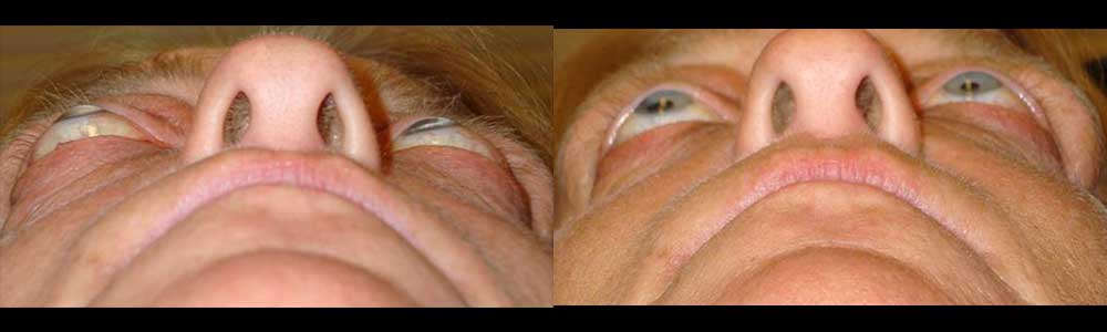 Middle age woman, with Graves related eye proptosis (protruding eyes), underwent bilateral orbital decompression surgery (with fat and bone removed behind eyeballs, creating more room for the eyeball to sink back). Preop (left) and 3 months postoperative (right) photos show the position of the eyeballs.