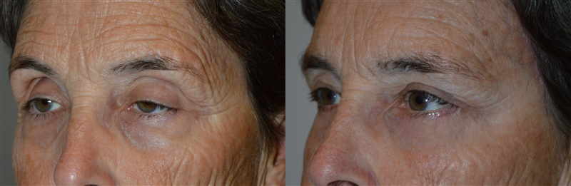 Eyebrow Lift Surgeon in Los Angeles