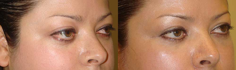 Young female with mild to moderate protruding eyes (large eyes) underwent orbital decompression surgery through hidden eyelid incisions (with fat and some orbit bone removed behind the eyeball) which allowed the eyeballs to go back, giving the desired eye shape and size. Preop and 3 months postoperative photos are shown.