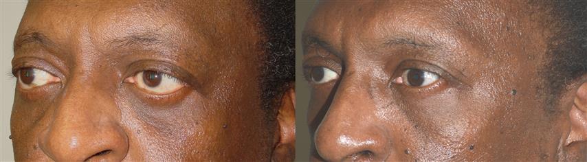 Middle age man, with thyroid eye disease (Graves disease), with protruding eyes and lower eyelid retraction with sclera show and lagophthalmos (unable to fully close his eyes), underwent orbital decompression surgery (to push the eyeball back) followed later by lower eyelid retraction correction (internal approach, without graft) and canthoplasty to raise the lower eyelids in more normal location. Note improved eye shape and size. Before and 3 months postoperative photos are shown.