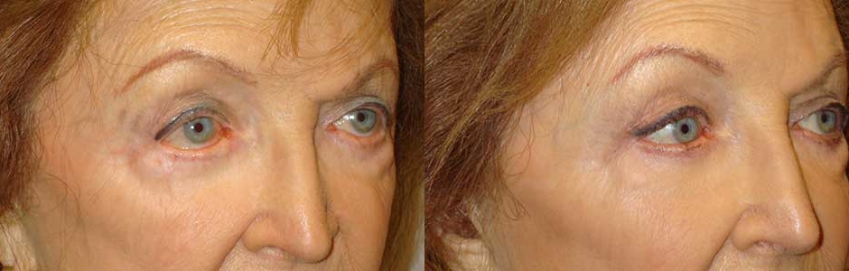 Lower Eyelid Corner Slant Surgery in LA