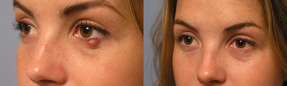 Eyelid Infection Removal Procedure