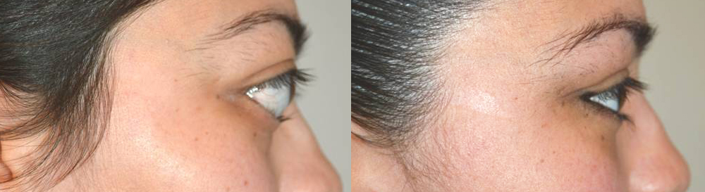 24 year old female, was unhappy with severe bulging eyes and lower eyelid retraction (pulled down) from Grave’s disease, with significant change in eye and facial appearance. She also suffered from lagophthalmos (unable to fully close her eyes) with dry eyes. She underwent bilateral orbital decompression surgery (eye socket bone and fat removed from behind the eyeball to push back the eyeball) and lower eyelid retraction surgery (to raise the lower eyelids). Note improved eye appearance and function (eye is able to close now). Before and 2 months postoperative photos are shown.