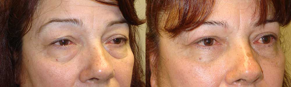 Cosmetic Droopy Eyeball Operation Procedure