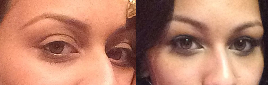 29 year old female, with relatively bulging eyes (large eyes) and surrounding hollowness around the eyes, underwent cosmetic orbital decompression (fat and some behind eyeball removed to allow the eyeball to sink back) and fat injection in upper and lower eyelids, to give more youthful eye appearance. Preop and 3 months postoperative photos are shown.