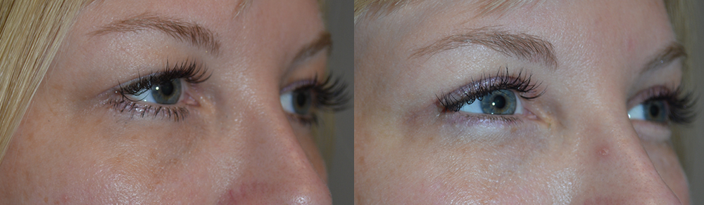 Upper Eyelid Extra Skin Removal Procedure