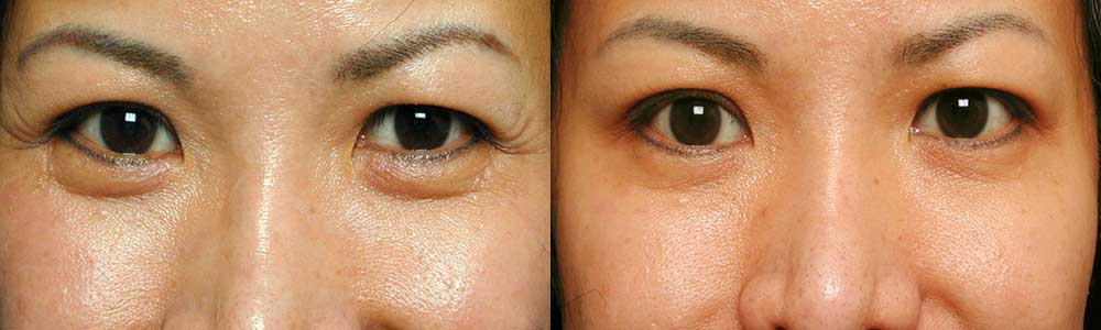 Beverly Hills Anti-Aging Eye Treatment