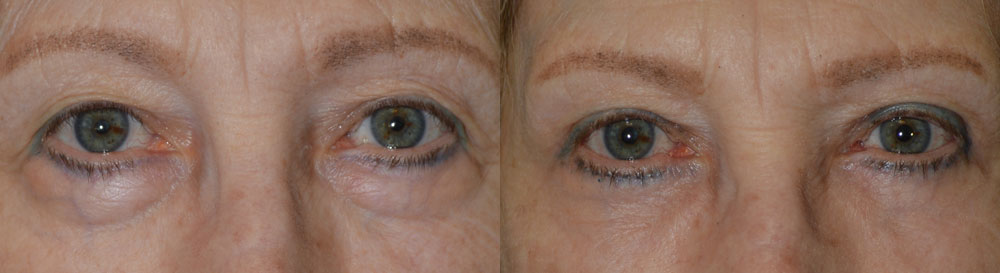 68 year old female, wanted eye rejuvenation to less tired and old. She has extra upper eyelid skin, resting on her lashes, which prevent proper application of makeup. She also has under eye bag (fat prolapse). She underwent cosmetic quad-blepharoplasty, meaning bilateral upper blepharoplasty (with skin removed from upper eyelids) and bilateral lower blepharoplasty (transconjunctival incision with fat redraping), under local anesthesia in the office. Note improved, natural eye appearance with patient looking more rested and youthful. Preop and 3 months postoperative photos are shown.
