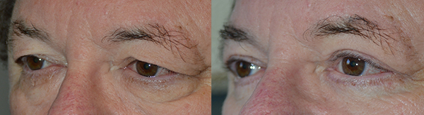 67 year old male, with saggy upper eyelids and under eye bags, wants eyelid rejuvenation. He underwent cosmetic eyelid surgery including upper blepharoplasty (“eyelid lift” to remove excess skin and tighten muscle) along with lower blepharoplasty (transconjunctival with fat repositioning and skin pinch). Notice more youthful, rested eye appearance in the after photo.