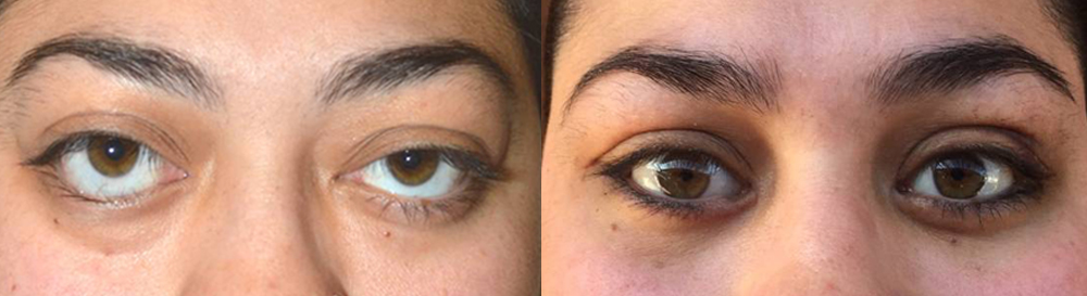 24 year old female, was unhappy with severe bulging eyes and lower eyelid retraction (pulled down) from Grave’s disease, with significant change in eye and facial appearance. She also suffered from lagophthalmos (unable to fully close her eyes) with dry eyes. She underwent bilateral orbital decompression surgery (eye socket bone and fat removed from behind the eyeball to push back the eyeball) and lower eyelid retraction surgery (to raise the lower eyelids). Note improved eye appearance and function (eye is able to close now). Before and 2 months postoperative photos are shown.