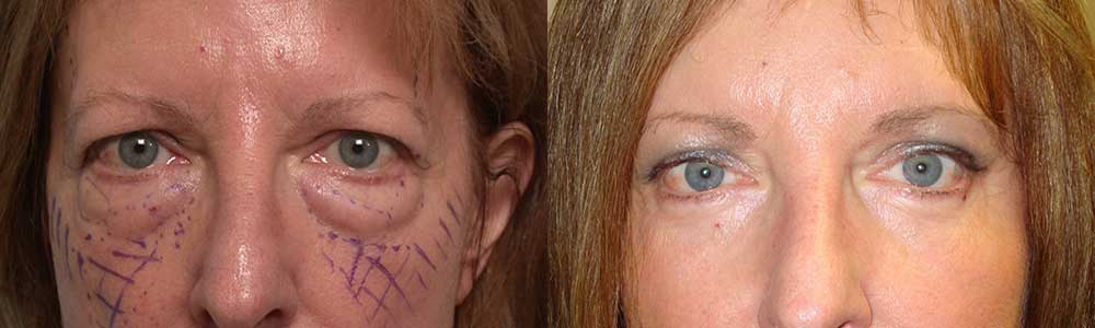 44 year old female, with puffy upper and lower eyelids and heavy forehead, underwent cosmetic upper blepharoplasty (“eyelid lift”), lower transconjunctival blepharoplasty (under eye fat removal using stitch-less inside eyelid approach), and endoscopic forehead lift, under sedation anesthesia. Note more rested, younger eye appearance with natural results. Preop and 3 months postoperative photos are shown.