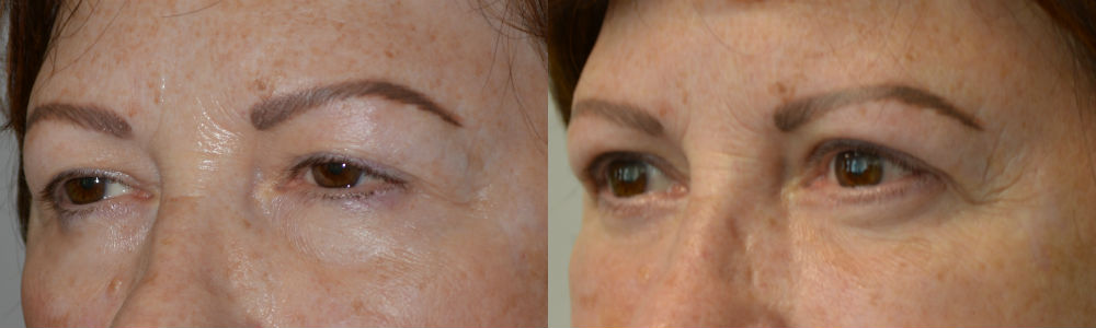 Middle age woman, with heavy droopy upper eyelids (ptosis) and excess upper eyelid skin and under eye bags, wanted eye rejuvenation. She underwent cosmetic eyelid surgery including upper eyelid ptosis repair (to lift the droopy upper eyelids), upper blepharoplasty (to remove excess upper eyelid skin), and lower blepharoplasty (transconjunctival with fat repositioning). 3 months postoperative photos show improvement in eye appearance, with more youthful natural look.
