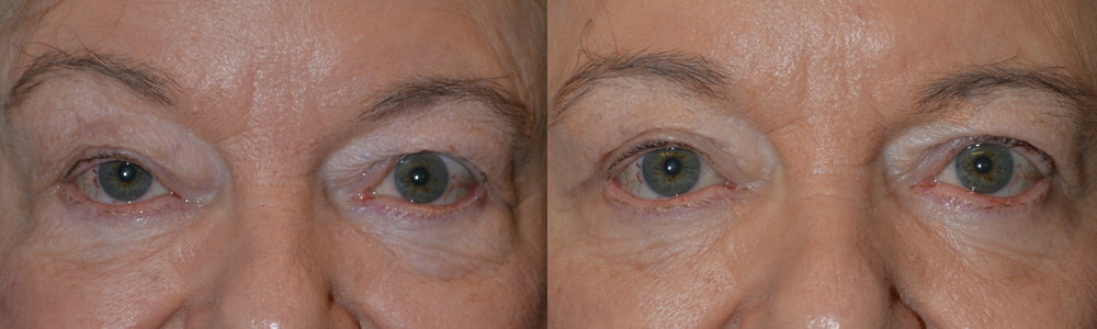 65+ year old female, complained of eye size asymmetry with right eye smaller (secondary to droopy right upper eyelid, ptosis). Note the right eyebrow is raised in order to help lift the droopy right upper eyelid. She underwent right upper eyelid blepharoptosis repair (droopy eyelid surgery; “lid lift”) under local anesthesia. Note the right eyebrow becomes more relaxed with improved eye symmetry in the 2 months postoperative photo.