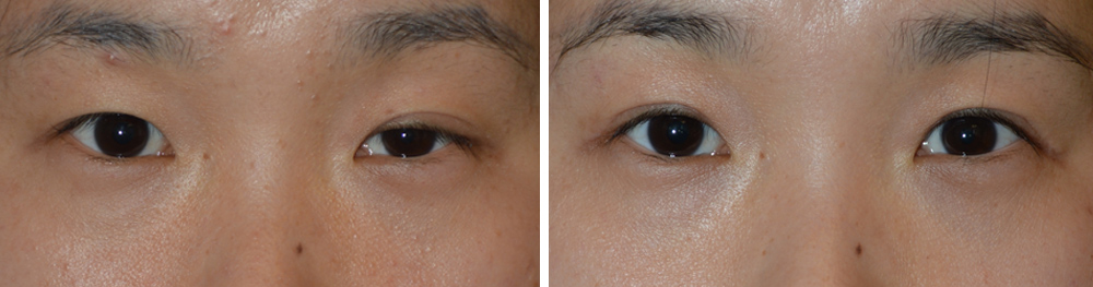 25 year old Asian female, with asymmetric upper eyelid folds and left upper eyelid ptosis (droopy upper eyelid secondary to Horner’s syndrome), underwent Asian upper blepharoplasty (with incision method to create eyelid crease) plus left upper eyelid ptosis surgery (to raise the left upper eyelid), under local anesthesia in the office. Note natural, more symmetric eyes in the 3 months postoperative photo (right photo).