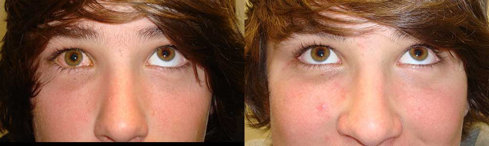 Young boy, with right orbital blow out fracture (secondary to golf ball injury) with inability to move the right eye up (left photo). He underwent orbital fracture surgery with implant placement (through hidden inside eyelid, conjunctiva incision; stitch-less) with eye movement restored as shown in this 3 months postoperative photo (right photo).