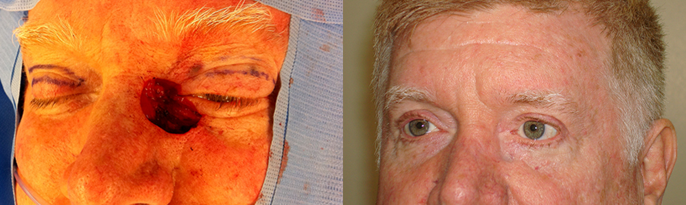 56 year old male, with large eyelid defect after eyelid basal cell carcinoma removal followed by reconstruction using multiple flaps to close the defect, with natural results and good function. Intraoperative and 3 months postoperative photos are shown.