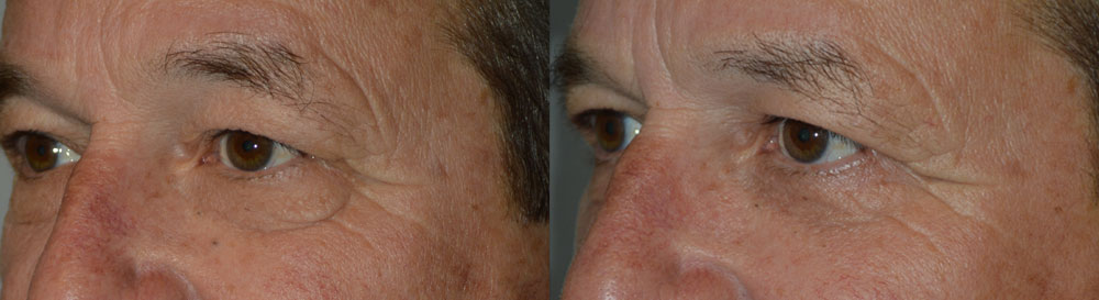 Middle age man, complained of lower eyelid wrinkles and loose skin and bags. He wanted conservative surgery to look younger and better. He underwent male lower blepharoplasty using transconjunctival approach to address under eye bags plus outside skin pinch method to remove excess skin. This aesthetic eyelid procedure was done under local anesthesia in the office, with quick recovery. Preop and 2 months postoperative photos are shown.
