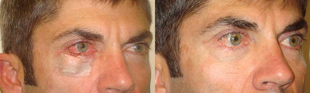 40 year old male, with right lower eyelid defect after Mohs procedure to remove right lower eyelid basal cell carcinoma, resulting from sun damage in light skin individual (right photo). Note nearly half of the lower eyelid is missing. He then underwent right lower eyelid skin cancer reconstruction under local anesthesia. Before and 3 months postoperative photos are shown.