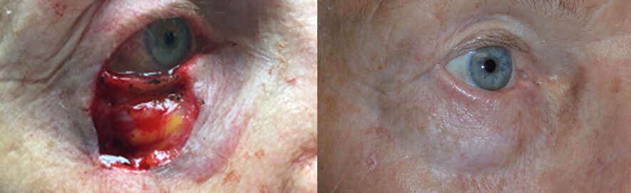 80+ year old woman, with near total right lower eyelid defect after eyelid skin cancer (basal cell carcinoma) excision. She underwent eyelid reconstruction using lateral flap and eyelid skin graft under local anesthesia. Note natural appearing results with minimal scarring, and normal eye function.