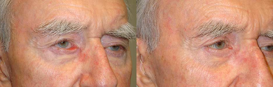 70 year old male, with segmental right lower eyelid cicatricial ectropion (eyelid rolls away, showing redness inside the eyelid), secondary to previous skin cancer surgery, underwent reconstructive eyelid ectropion repair with skin graft. Before and 2 months postoperative photos are shown.