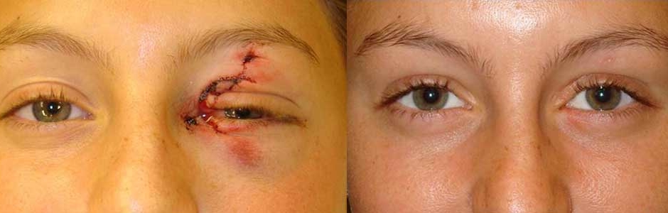 Young female teenager who suffered full-thickness left upper and lower eyelid laceration plus canalicular laceration (tear duct laceration) from surf board accident. She underwent eyelid, eyebrow and canalicular laceration repair. Note natural appearing results with minimal scarring. Preop and 3 months postoperative photos are shown.