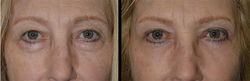Beverly Hills Under Eye Bags Treatment