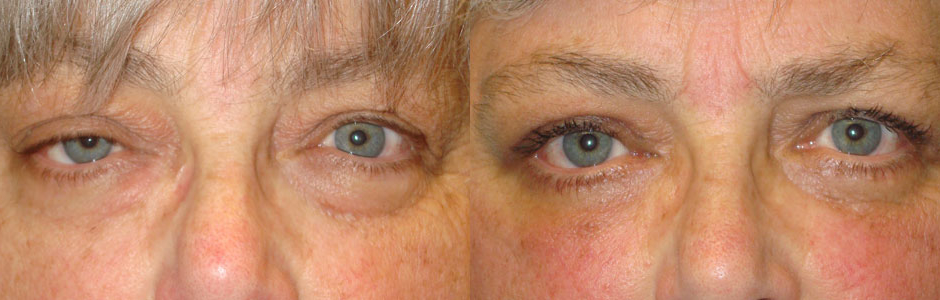 Middle age woman, complained of asymmetric eyes secondary to right upper eyelid ptosis (droopy) along with excess upper and lower eyelid fat pockets and loose skin. She underwent eyelid surgery including right upper eyelid ptosis surgery (eyelid lift through external approach), bilateral upper blepharoplasty (upper lid skin removal), and lower blepharoplasty (transconjunctival with fat repositioning and skin pinch), under local anesthesia in the office. Note improved eye size symmetry and youthful eye appearance in the postoperative photo 3 months after eyelid surgery.