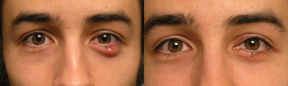 Ocular Irritation Treatment Surgery