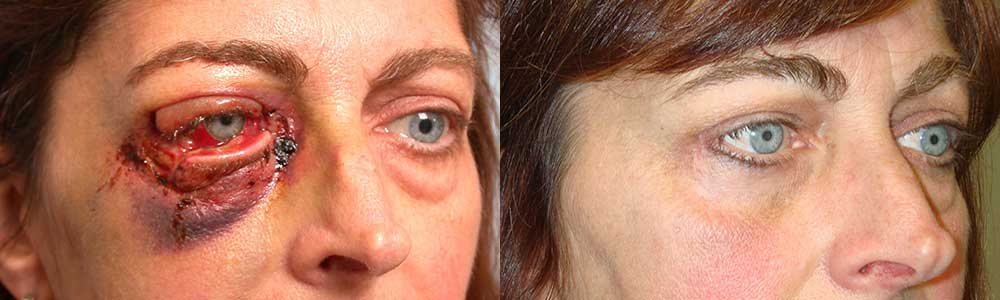 Middle age woman with multiple right eyelid lacerations underwent reconstructive eyelid laceration repair. Note natural results with minimal scarring. Preop and 3 months postoperative photos are shown.