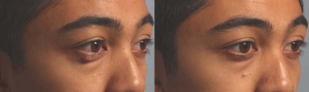 Oily Tear Gland Surgery Procedure