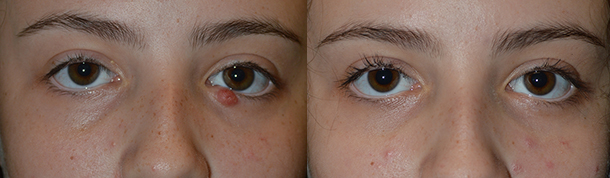 Blocked Tear Gland Treatment Surgery