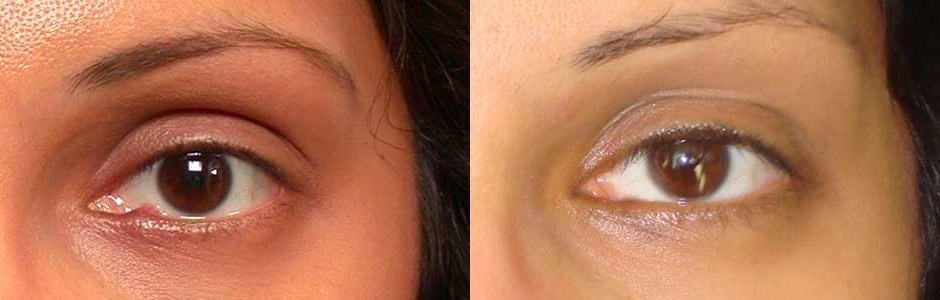 Bacterial Infection Eyelid Treatment