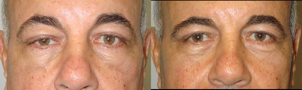 Second Eyelid Surgery by LA Doctors